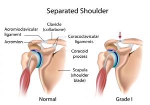 Separated Shoulder (AC Joint Sprain)